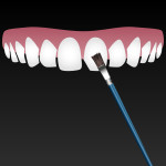 dental bonding roseville