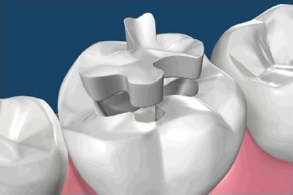 dental inlay in roseville ca
