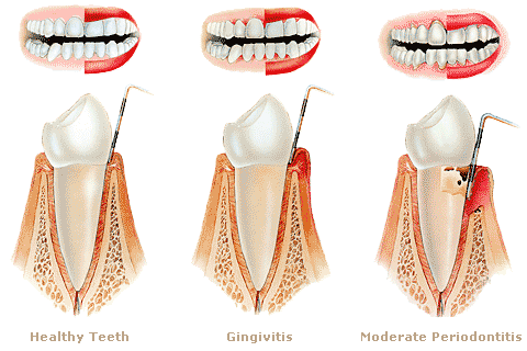 gingivitis and periodontitis roseville