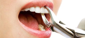 tooth extraction in roseville