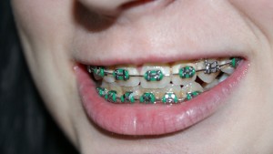 dental braces pic