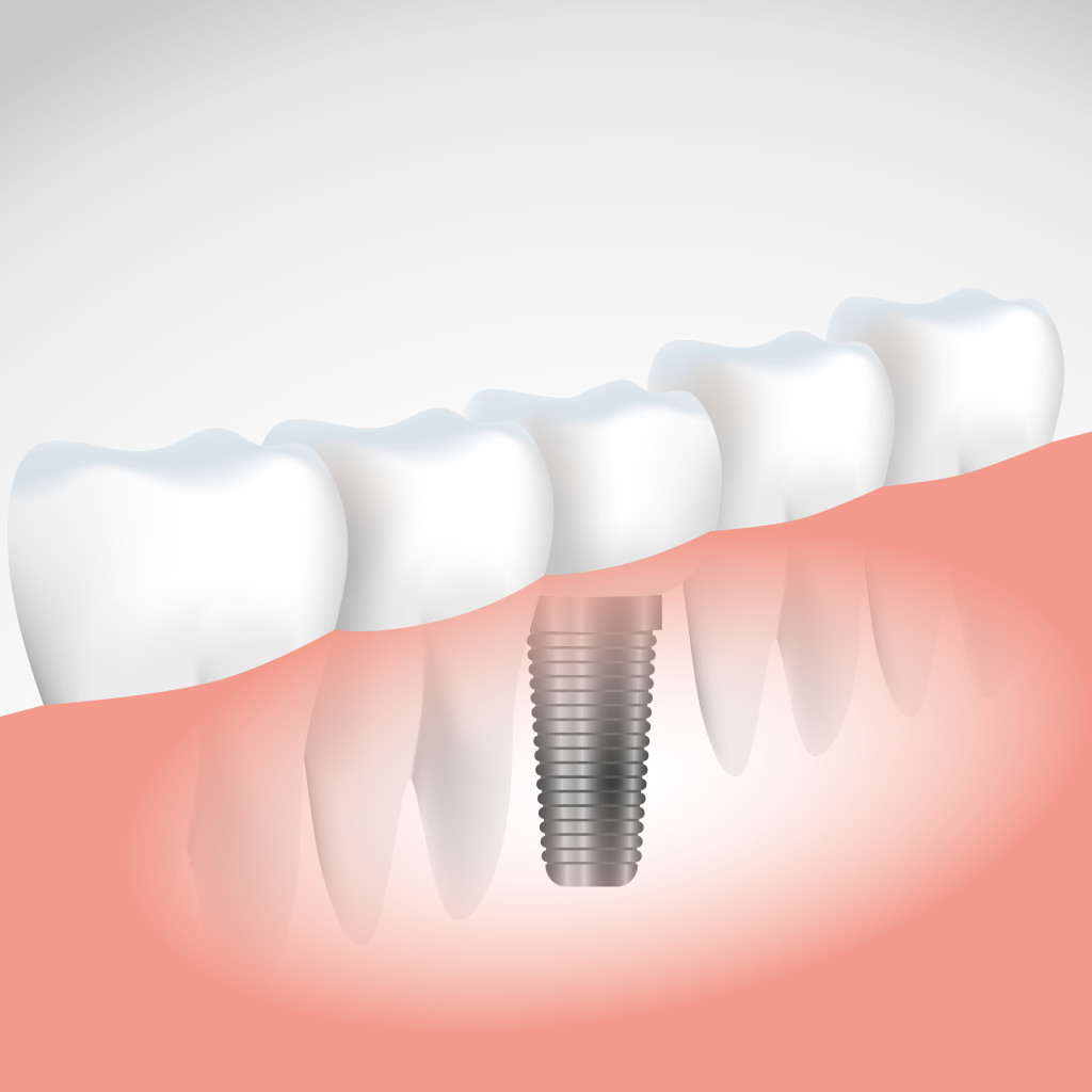 Dental Implants in Roseville, California Ace Dental